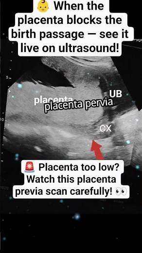 Placenta Previa on Ultrasound | Watch the Placenta Location Carefully! #ultrasound