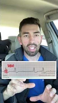 Second degree Type II heart block for nurses!