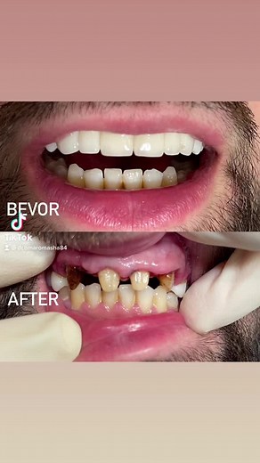 Transform Your Smile: Dental Procedure Before and After