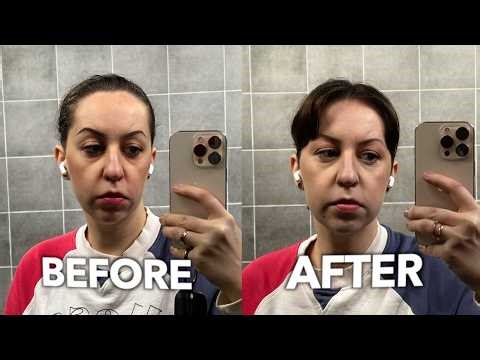 SMAS Lifting Before & After | Real Result
