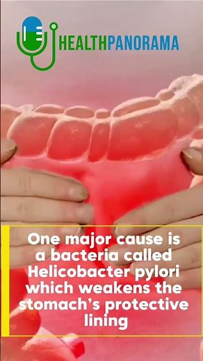 What Causes Ulcers? The Truth Many People Don’t Know