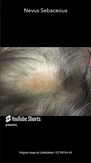 Nevus sebaceous