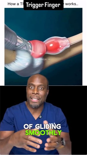 Zikky Kanu, M.D. on Instagram: "If your finger locks, clicks, or suddenly snaps straight, this might be trigger finger. It’s not a joint issue, it’s a tendon getting stuck in a tunnel that’s too tight. Let’s break it down. #TriggerFingerExplained #TendonHealth #OrthoFacts #HandPain #MedicalEducation Disclaimer: This content is for educational purposes only and should not be used as a substitute for professional medical advice, diagnosis, or care"