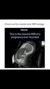 MRI of Pregnancy | Medical Talks