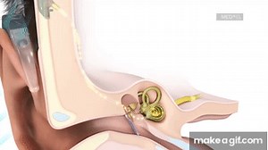 How Do Cochlear Implants Work? | MED-EL on Make a GIF