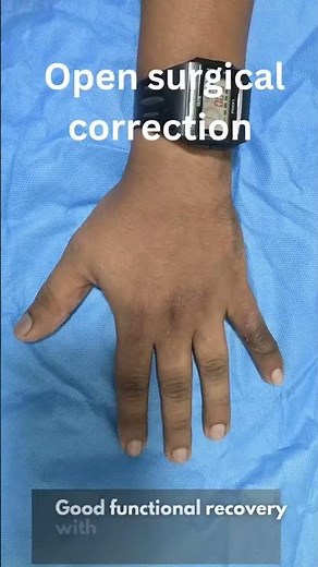 Boutonnière Deformity Correction | Before & After / Thrissur/ hand surgery expert