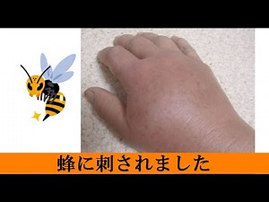蜂に刺された！(+_+) 【怖い！痛い！】でもね だいたい3日で落ち着きます