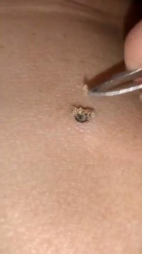 20 years old blackhead from my grandpa's back