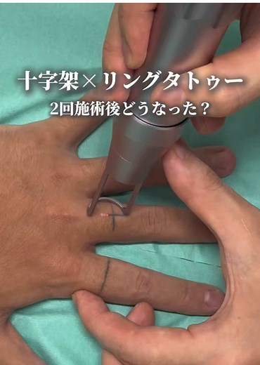 十字架×リングのタトゥー除去を2回したら…！ 個人差はありますが、ここまで綺麗になります◎ タトゥーのお悩みはぜひフルカラー対応のルラ仙台院へ😌💡 カウンセリング無料です！ お気軽にご相談ください！ ▽タトゥー除去▽ 【副作用・リスク】 カサブタ・色素沈着・赤み・稀に水疱形成等 【料金】 1~5㎠モニター¥16,500～ 🏥住所 宮城県仙台市青葉区中央3丁目1-22 EQUINIA青葉通り8階 「仙台駅」北出口2より徒歩1分 ☎️0120-390-510 #ルラ美容クリニック #ルラ美容クリニック仙台院 #タトゥー #ピコレーザー #肌質改善 @橋本英樹【ルラ仙台院 院長】