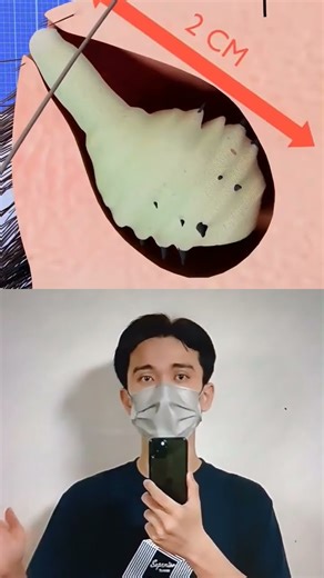 The Botfly Under Your Skin #shorts