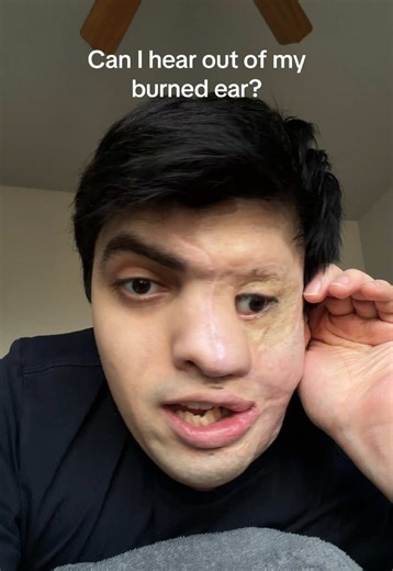 My ear drum is fine just missing the satellite dish #burnsurvivor #ear #sergioreyna #hearingloss