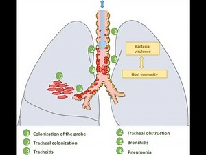 Tracheitis (inflammation of the trachea Or windpipe) ; Causes, Symptoms, Diagnosis, Treatment