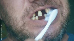toothless man brushing his teeth. loose teeth in a middle-aged man. before a medical examination.