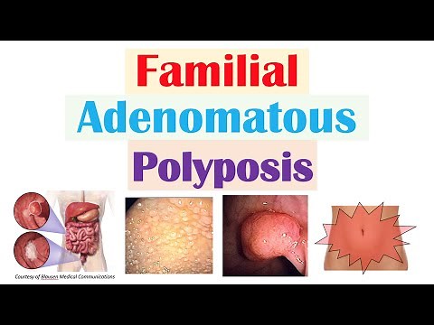“Colon Cancer That Runs in Families” (Familial Adenomatous Polyposis), APC Gene, Symptoms, Treatment