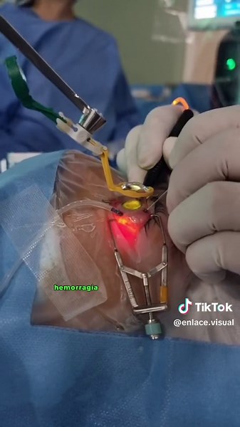 Todo sobre la vitrectomía: cirugía para enfermedades oculares