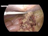 Laparoscopic Repair of Recurrent Umbilical Hernia • Video • MEDtube.net