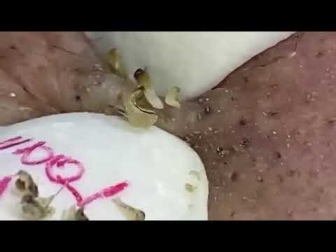 Satisfying 12-minute blackhead removal session — so relaxing!