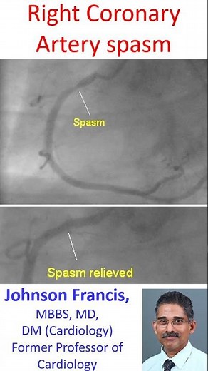 Right Coronary Artery Spasm