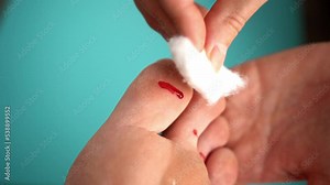 Injury to the pad of the big toe. The wound is bleeding. First aid, wound treatment.