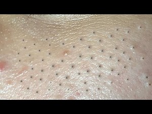 Huong Da Nang Acne Treatment #277