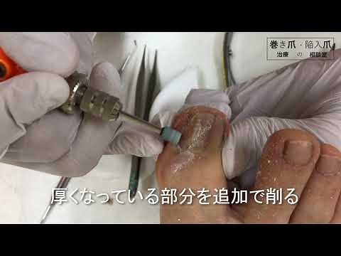 巻き爪 / 爪甲剥削法で痛み除去(爪削り)：巻き爪・陥入爪治療の相談室 Ingrown Toenails Nail Scraping method