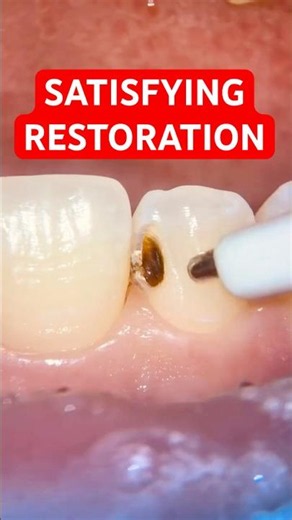 Front Tooth Cavity RESTORED Step by Step 🦷✨