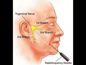 Trigeminal Neuralgia