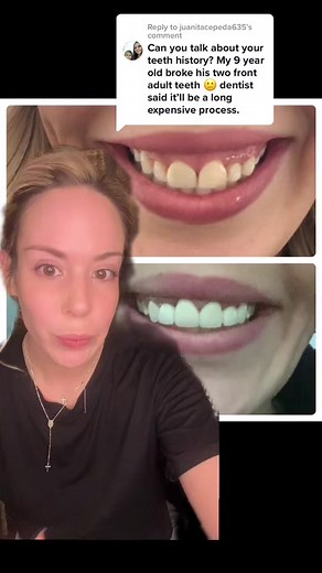 Understanding the Importance of Dental Veneers