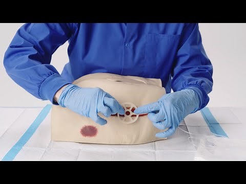 Tips on How to Apply NATROX® O₂ for Non-Healing Surgical Wounds