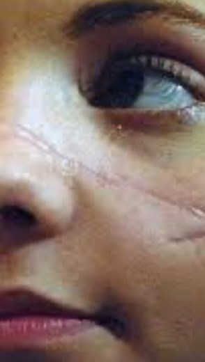Skating on Instagram: "One of the most tragic accidents of figure skating Jessica Dube was hit by skate blade of her partner Bryce Davison on her face on the 8th February 2007 during a spin. She has had a scar on her face ever since (you can see it in the cover of this video) #jessicadube #jessicadubebrycedavison #iceskating #figureskating #buzpateni #iceskater #icedance"