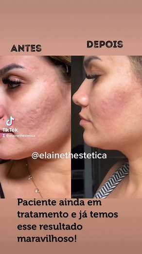 Microagulhamento: Resultados Incríveis para Cicatrizes de Acne