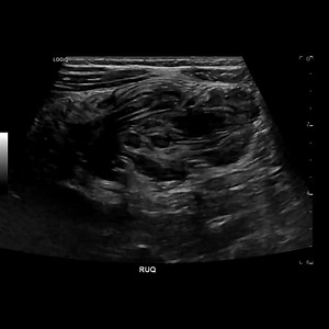 7.2K views · 268 reactions | Ileocolic Intussusception successfully reduced with air enema | John Z Wetmore | Facebook