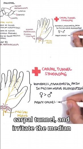 Numbness in the thumb, index, and middle fingers? #clinicalanatomy #mediannerve #handanatomy
