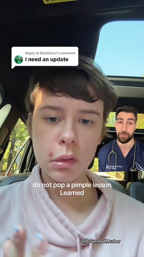 Risks of Popping Pimples: A Cautionary Guide