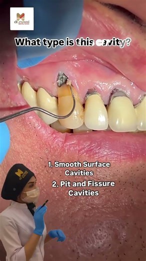 WHAT TYPE OF CAVITY IS THAT? 😬🦷