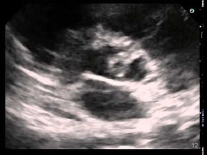 Bicuspid Aortic Valve