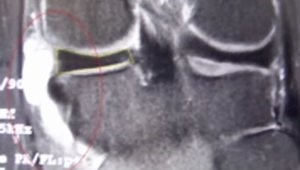 Arthroscopic Decompression of Meniscal Cyst