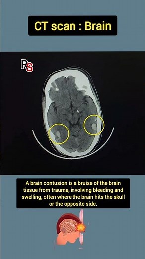 Brain Contusion on CT Scan 😱 | Don’t Miss This Head Injury! #radiology #shorts