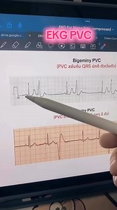 110K views · 1.8K reactions | Bigeminy PVC#EKG#EKGfornurse#ความรู้พยาบาล#ห้องพยาบาล | ห้องพยาบาล | Facebook