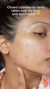 🔬 Closed comedones = clogged pores trapped under the skin. They don’t pop like pimples, and they take FOREVER to go away. The main culprits? 🚫 Excess oil & dead skin buildup 🚫 Heavy, pore-clogging products 🚫 Inconsistent exfoliation 💡 How to treat them? ✔️ Salicylic Acid (BHA) – Clears out clogged pores ✔️ Retinoids (Adapalene, Tretinoin) – Speeds up skin renewal ✔️ Lightweight, non-comedogenic skincare – Let your skin breathe! ✔️ Hydration & patience – They don’t disappear overnight 😵‍💫 
