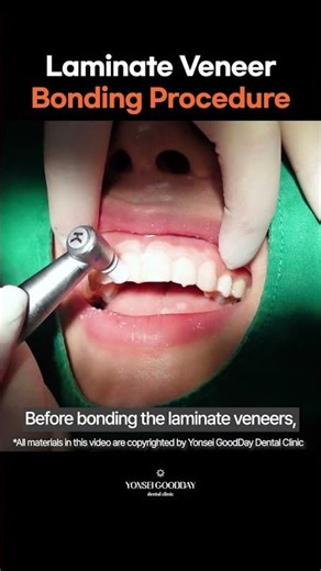 Laminate Veneer Bonding from Start to Finish - Inside the Process, #Laminate #veneer #smilemakeover
