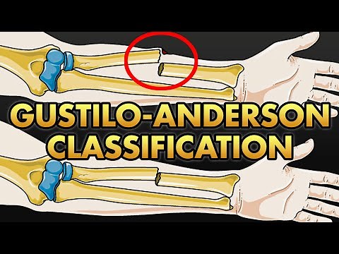 Gustilo Anderson Classification of Open Fractures