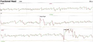 Unilateral Vestibular Loss | BalanceMD