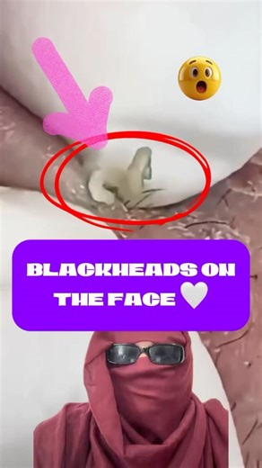 Is This The Most Satisfying Video on YouTube? 😊 #shorts #short #pimple #blackheads #viral #youtube