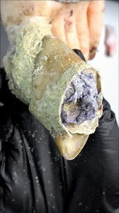 #toenailremoval #reels #ingrowntoenailremoval | Videos Asset