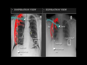 Basic Pediatric Chest X Ray Interpretation Part 1 | Radiology Lecture