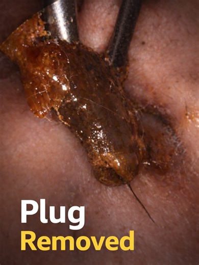 Effective Ear Wax Removal: Two Plugs and Olive Oil Benefits