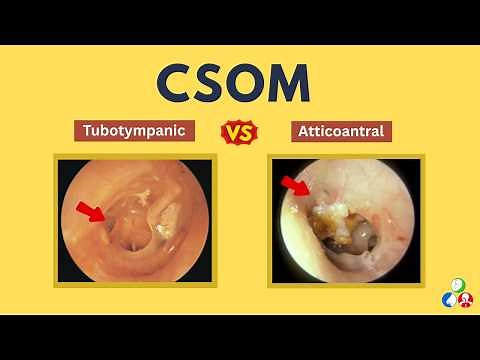 Chronic Suppurative Otitis Media (CSOM) | Tubotympanic | Atticoantral