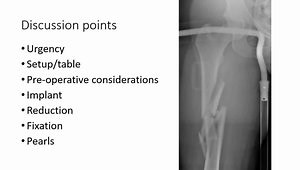 Case Presentation: How Should We Treat This Distal Femoral Fracture