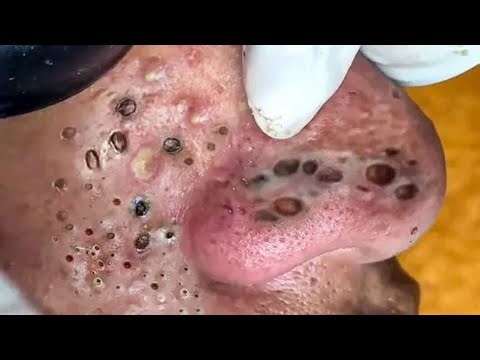 ASMR Spa Extraction – Extreme Blackhead Removal from Clogged Cheeks! ✨”